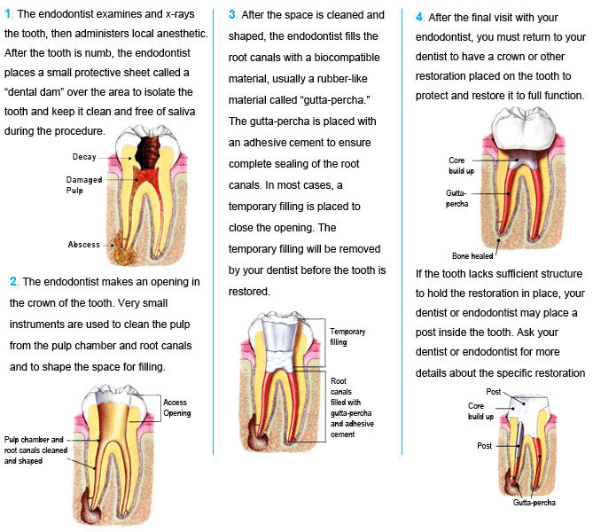 Endodontic Surgery Recovery Time at Danny Stacks blog